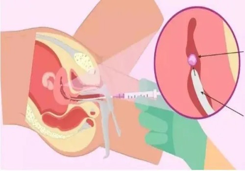 寧波三代試管助孕：產(chǎn)婦坐月子是42天還是30天？到底哪一個正確